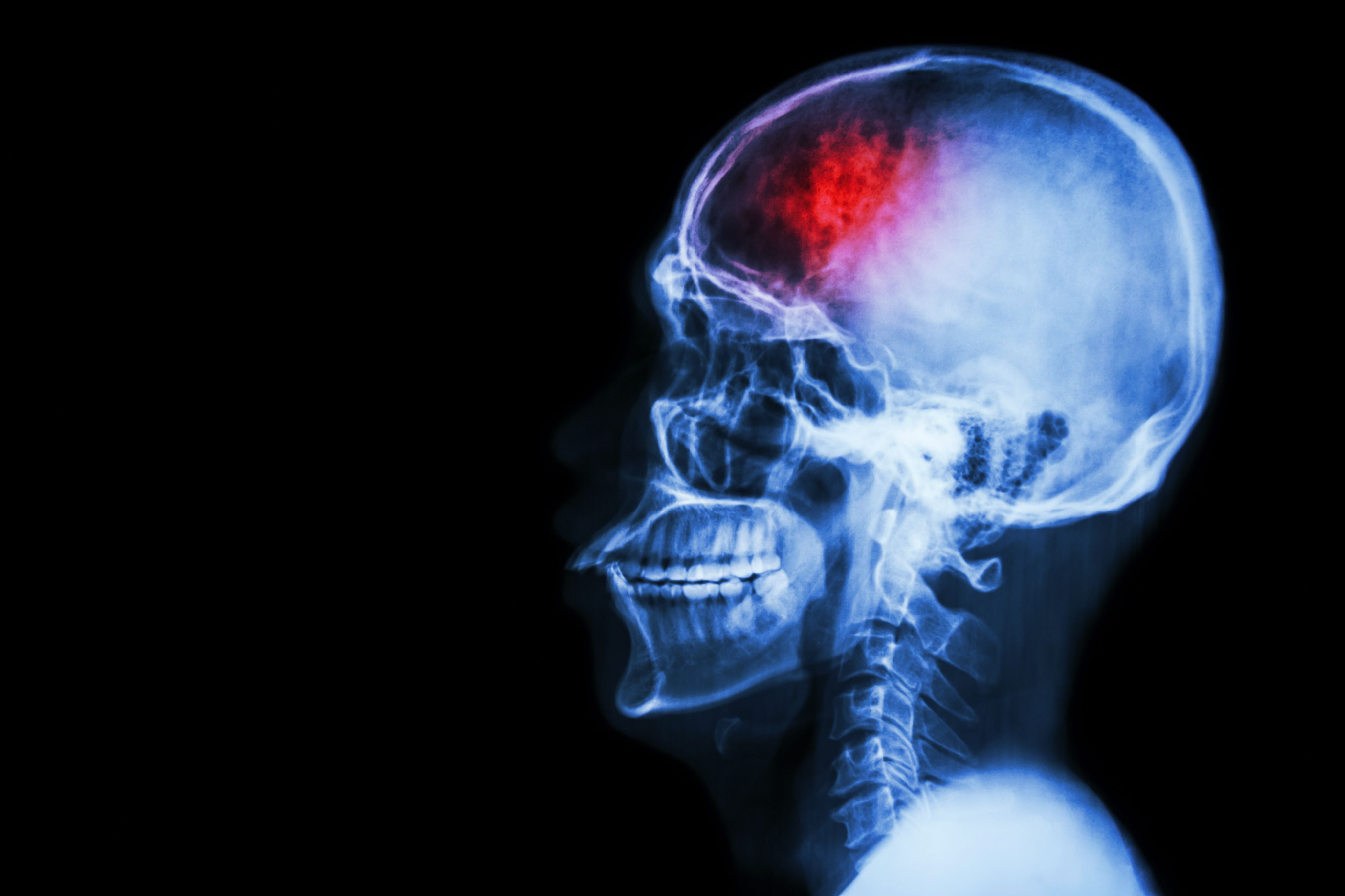 Rose: Meeting an unmet need for people with complex brain injuries